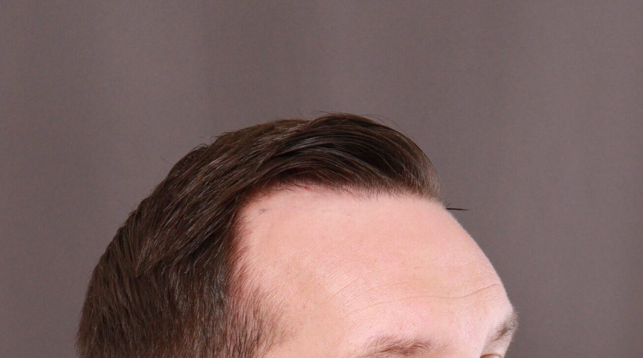 Before Image: FUE Hair Transplant by Dr. Henstrom - right-front-oblique