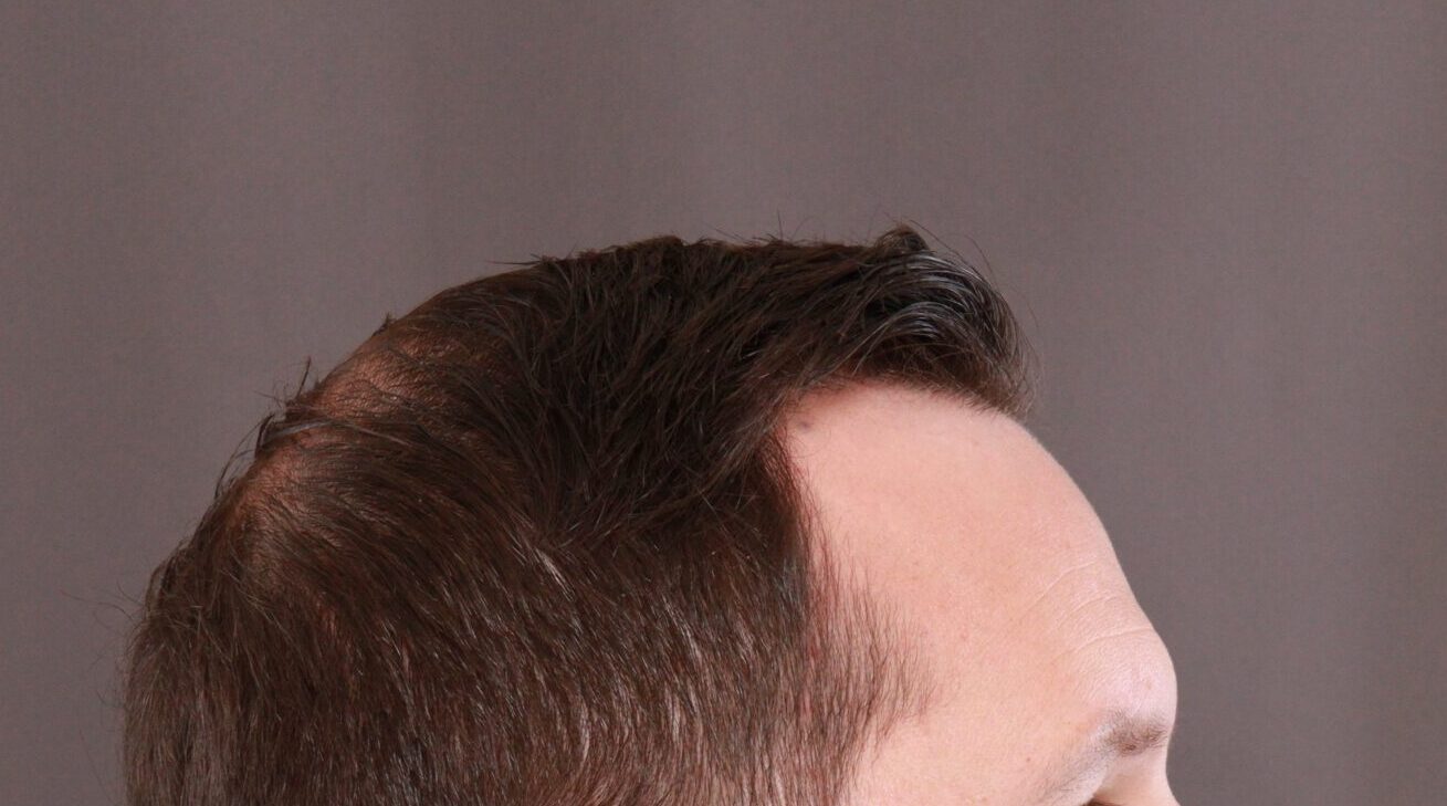 Before Image: FUE Hair Transplant by Dr. Henstrom - right-side