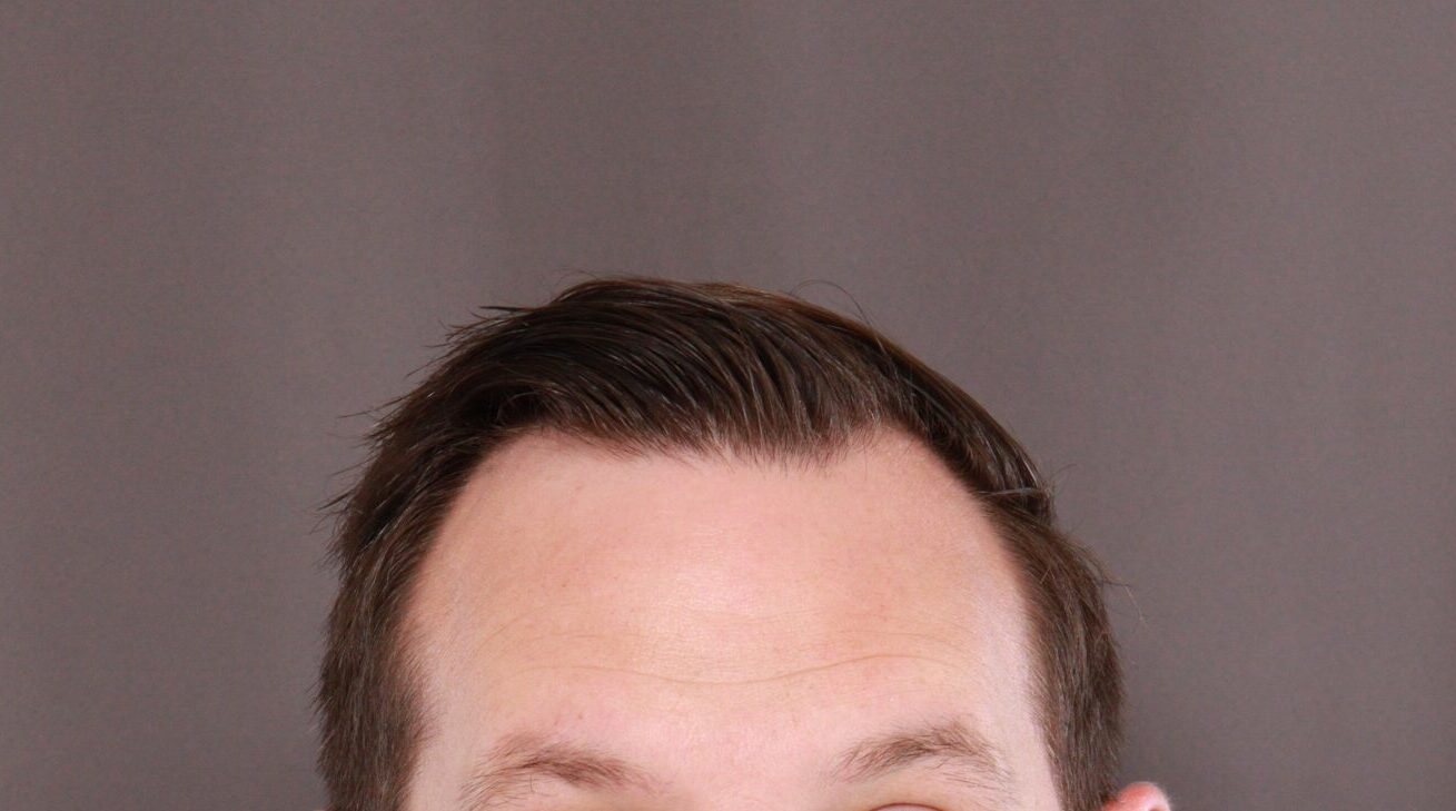Before Image: FUE Hair Transplant by Dr. Henstrom - front