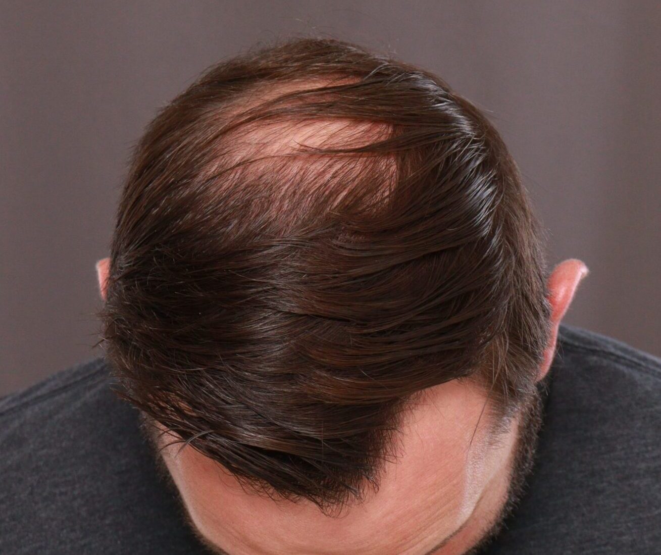 Before Image: FUE Hair Transplant by Dr. Henstrom - front
