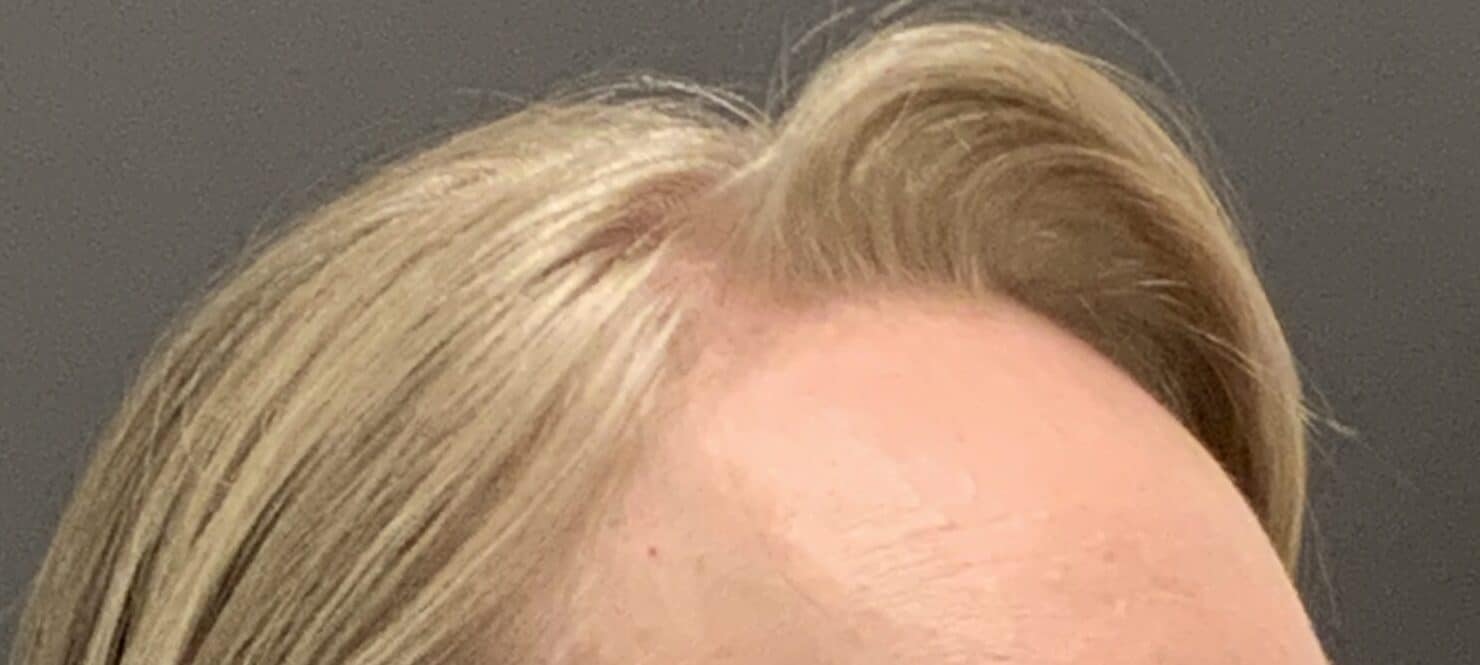 Before Image: FUT Hair Transplant by Dr. Thompson - right-front-oblique