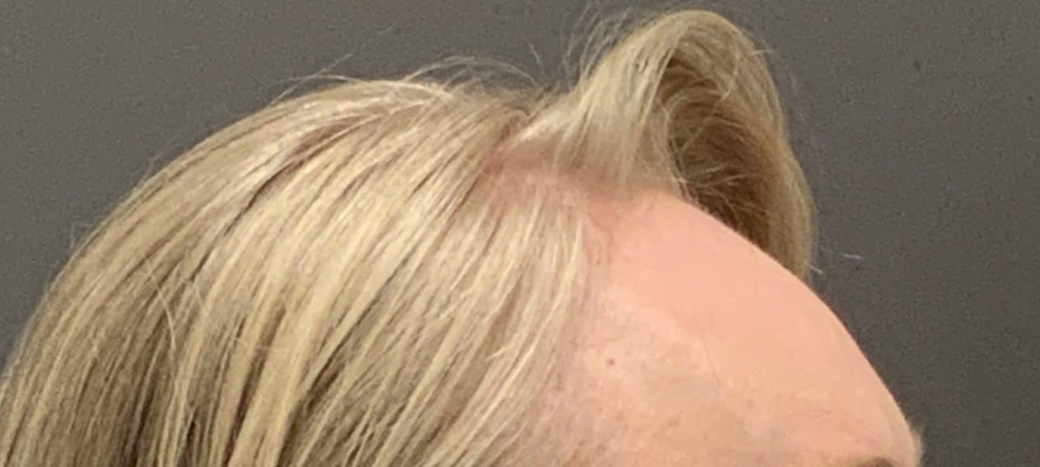 Before Image: FUT Hair Transplant by Dr. Thompson -