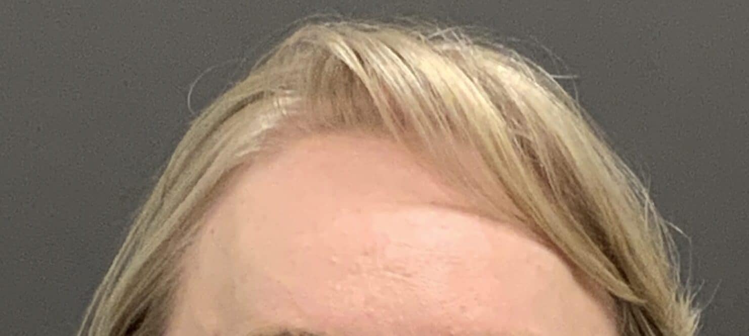 Before Image: FUT Hair Transplant by Dr. Thompson - front