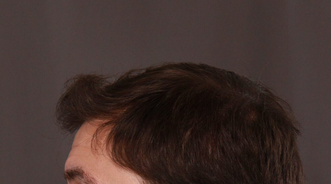 After Image: FUE Hair Transplant by Dr. Henstrom - left-side