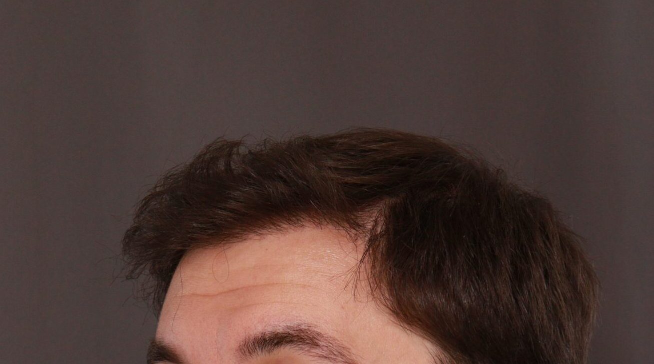 After Image: FUE Hair Transplant by Dr. Henstrom - left-front-oblique