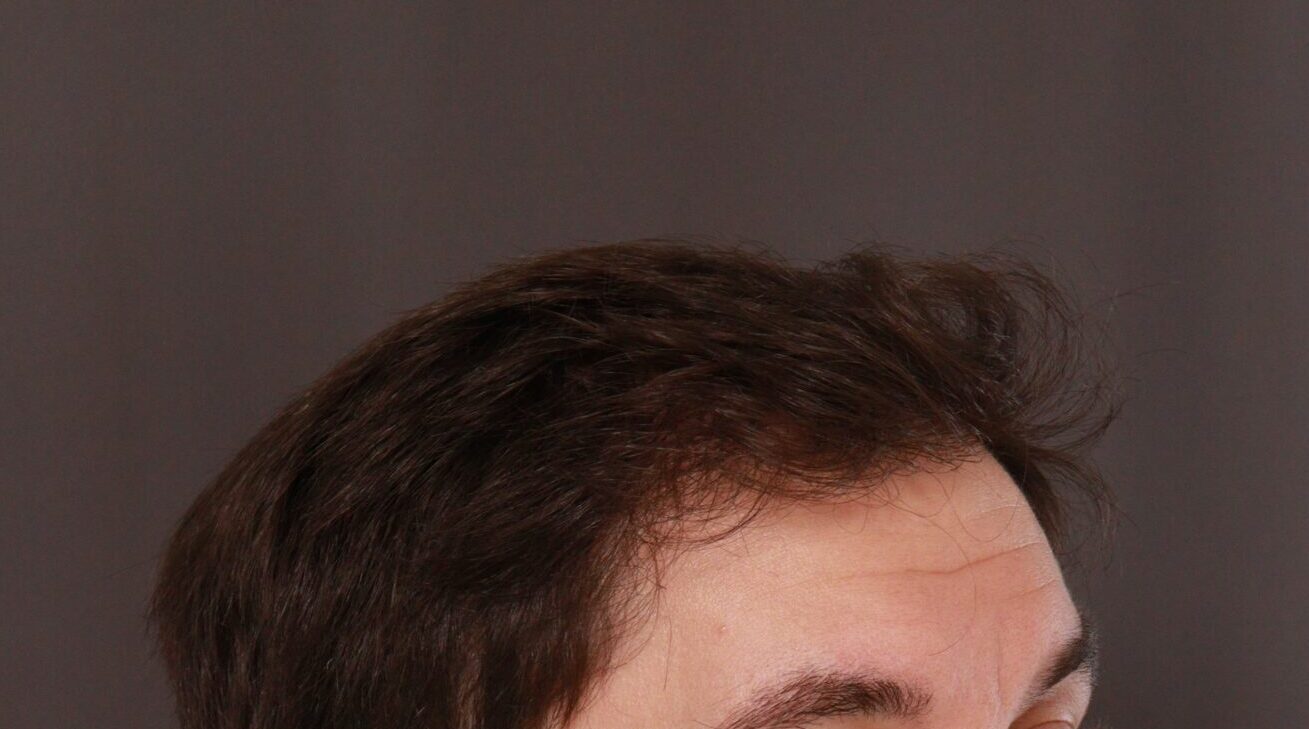 After Image: FUE Hair Transplant by Dr. Henstrom - right-front-oblique