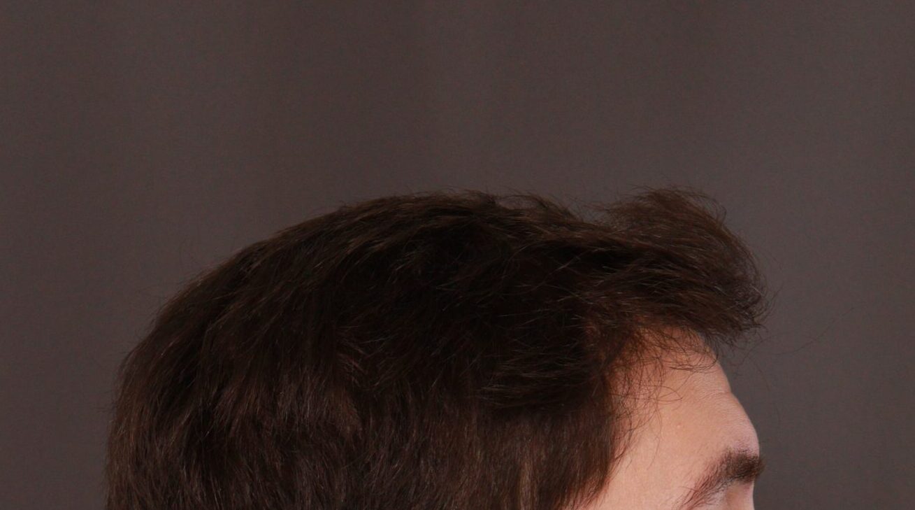 After Image: FUE Hair Transplant by Dr. Henstrom - right-side