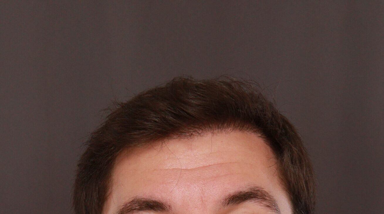 After Image: FUE Hair Transplant by Dr. Henstrom - front