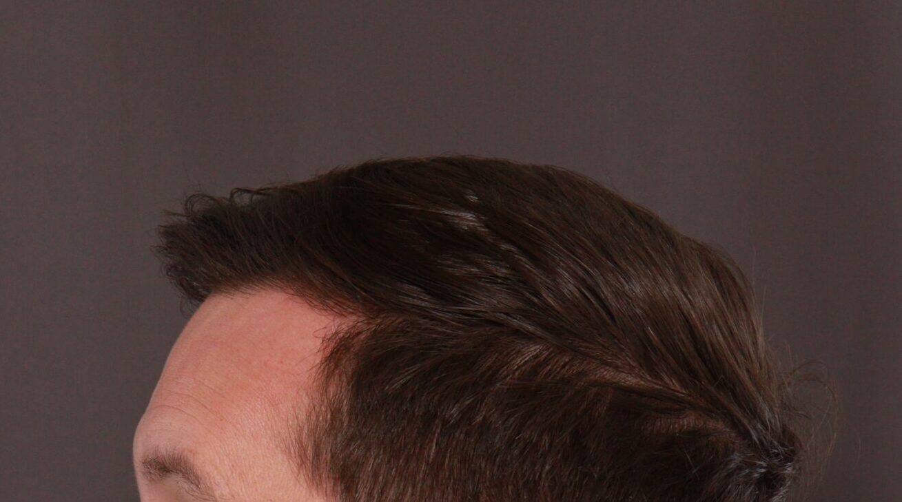 After Image: FUE Hair Transplant by Dr. Henstrom - left-side