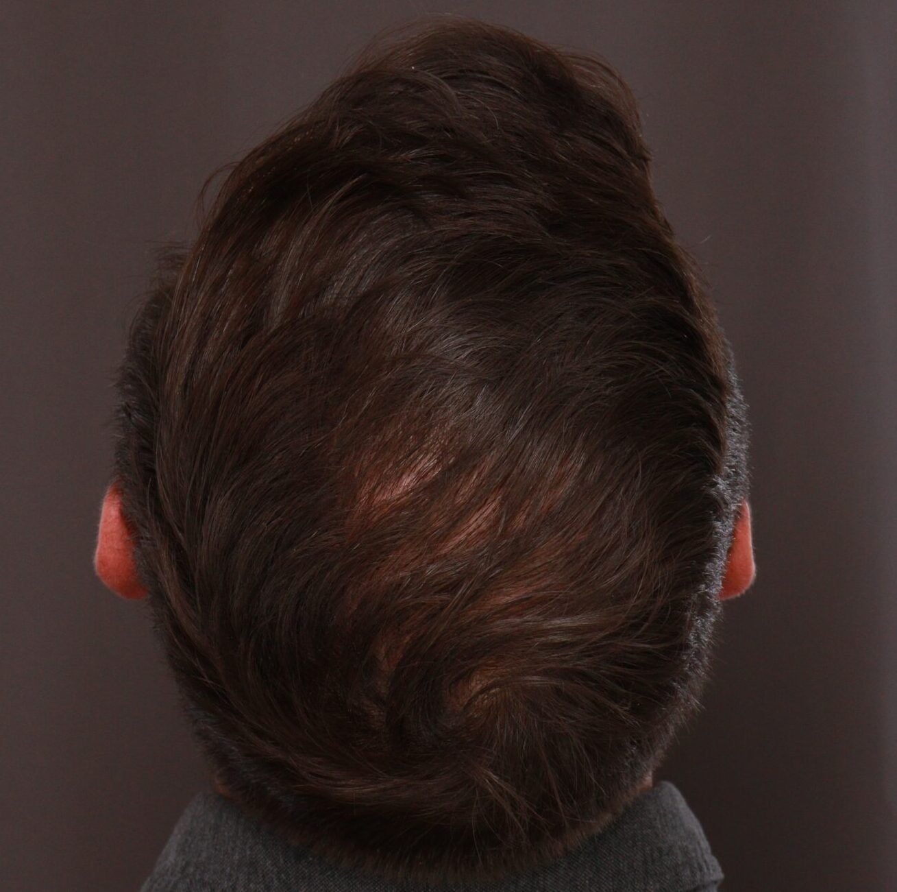 After Image: FUE Hair Transplant by Dr. Henstrom - other