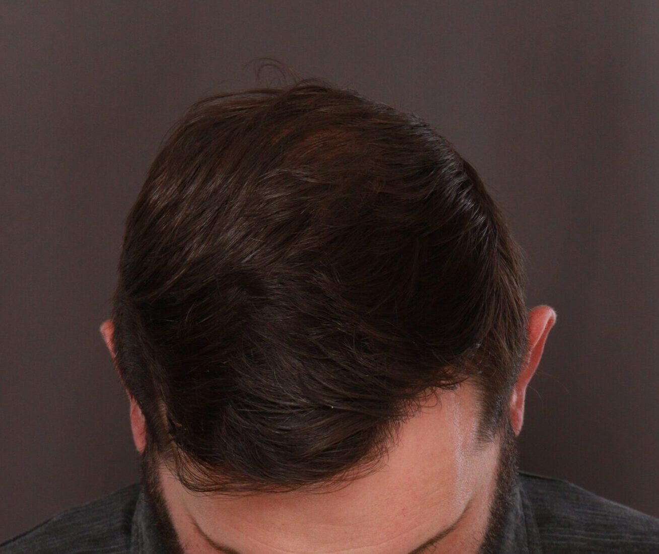 After Image: FUE Hair Transplant by Dr. Henstrom - front