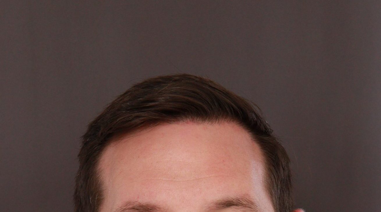 After Image: FUE Hair Transplant by Dr. Henstrom - front