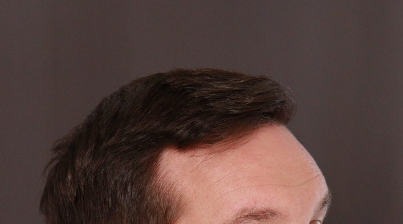 After Image: FUE Hair Transplant by Dr. Henstrom - right-front-oblique