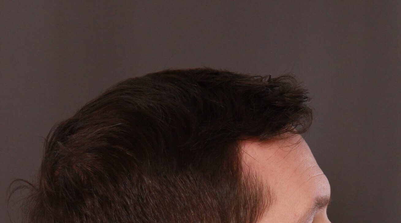 After Image: FUE Hair Transplant by Dr. Henstrom - right-side