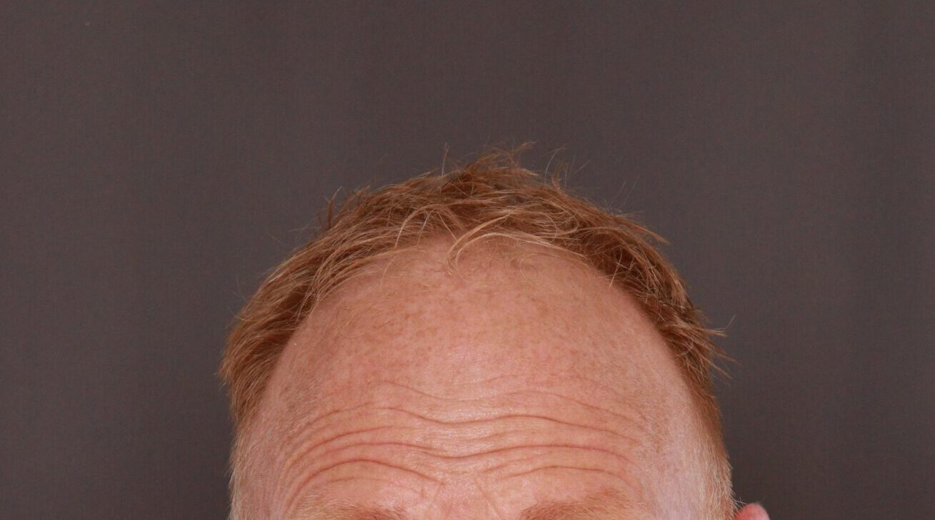 Before Image: FUT Hair Transplant by Dr. Thompson - front