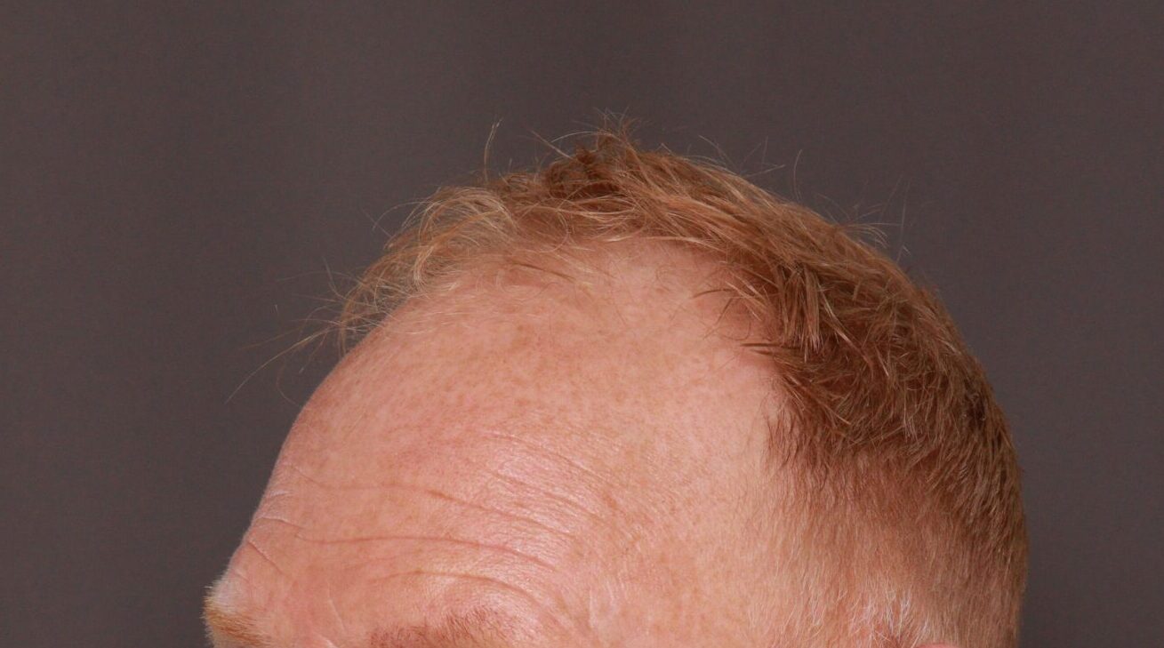 Before Image: FUT Hair Transplant by Dr. Thompson - left-front-oblique