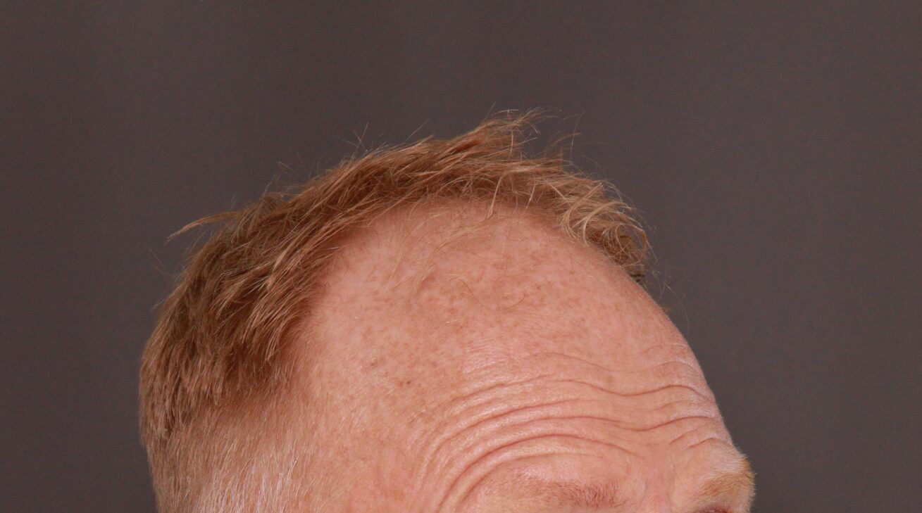 Before Image: FUT Hair Transplant by Dr. Thompson - right-front-oblique