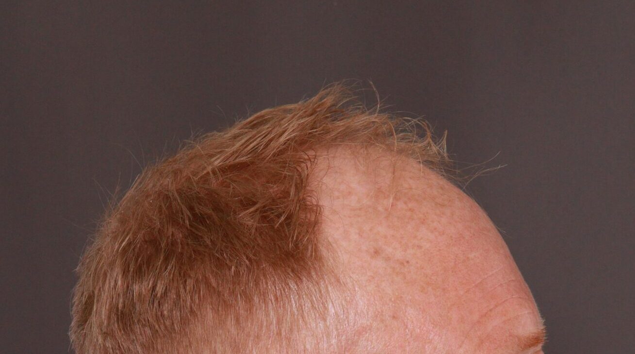 Before Image: FUT Hair Transplant by Dr. Thompson - right-side