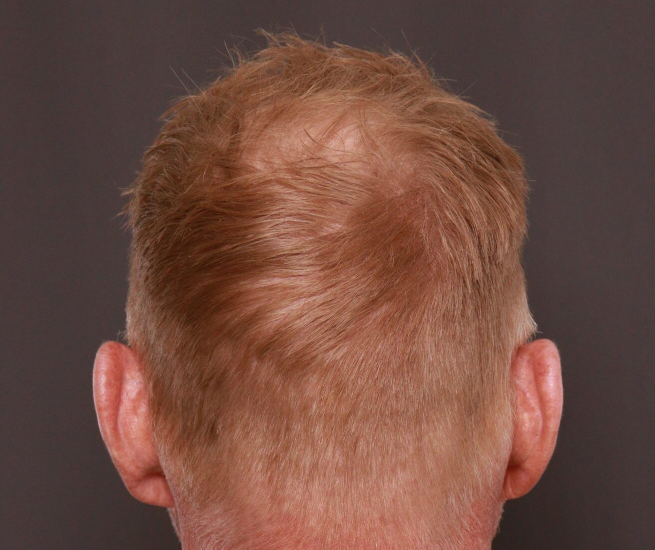 Before Image: FUT Hair Transplant by Dr. Thompson - other