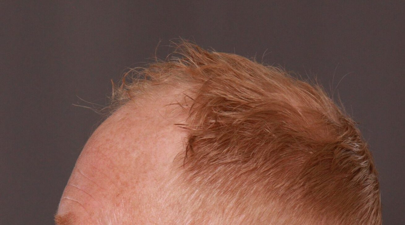 Before Image: FUT Hair Transplant by Dr. Thompson - left-side