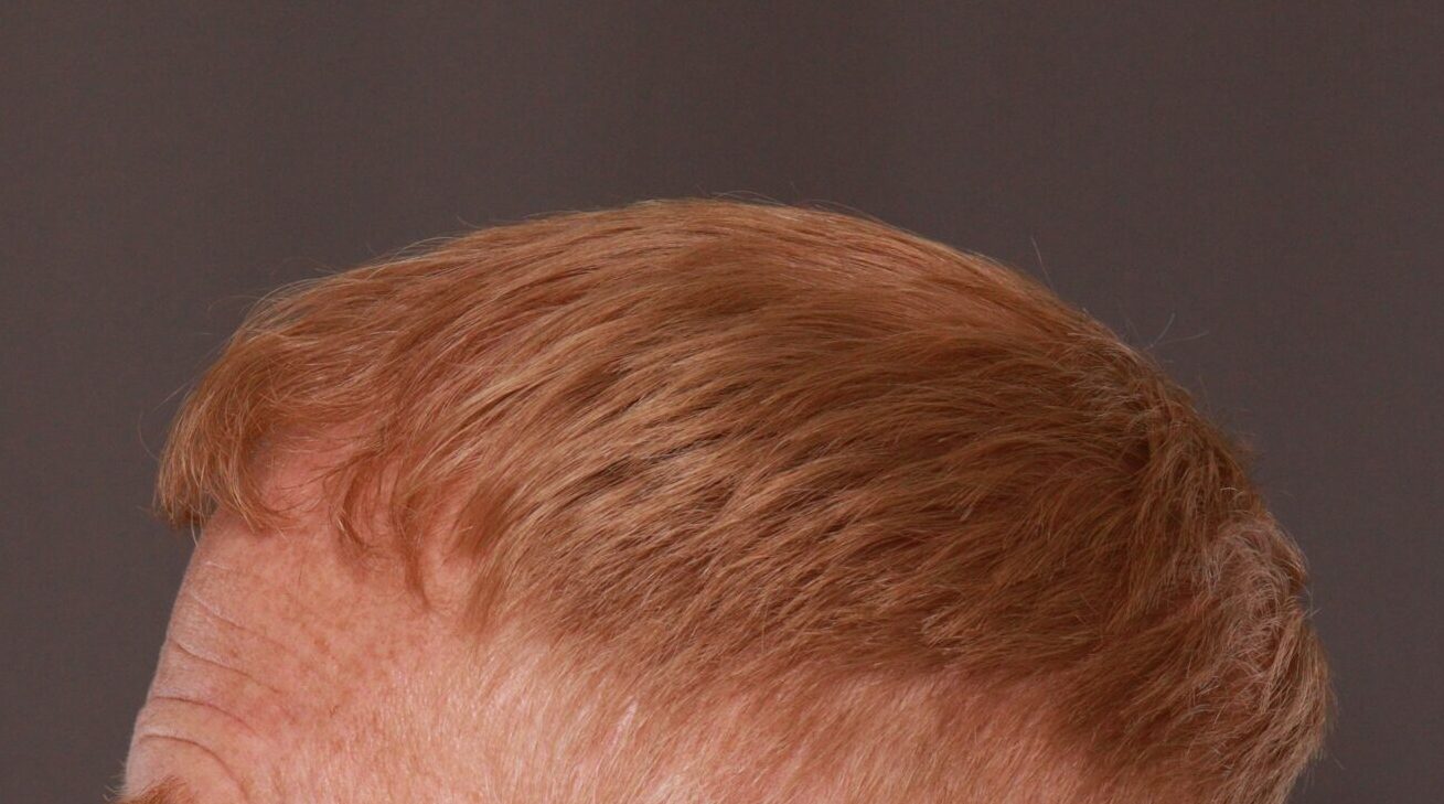 After Image: FUT Hair Transplant by Dr. Thompson - left-side