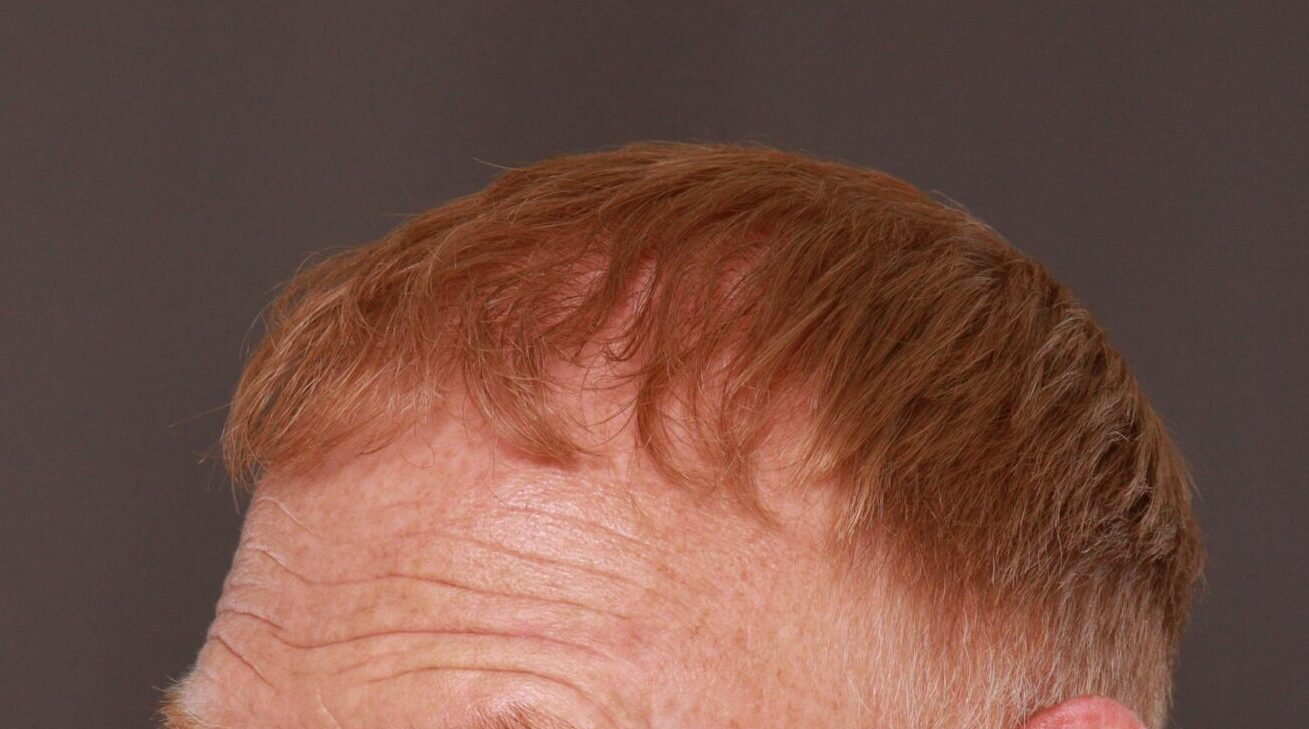 After Image: FUT Hair Transplant by Dr. Thompson - left-front-oblique