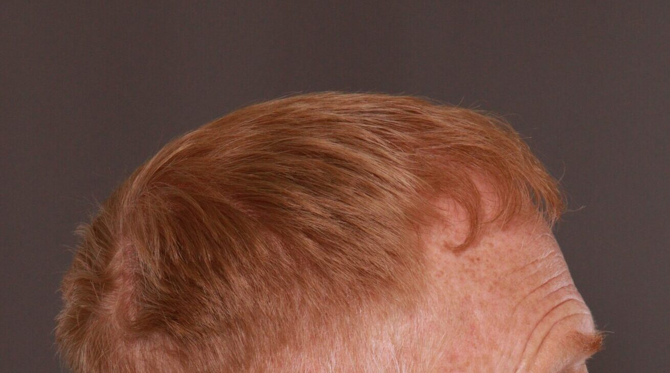 After Image: FUT Hair Transplant by Dr. Thompson - right-side
