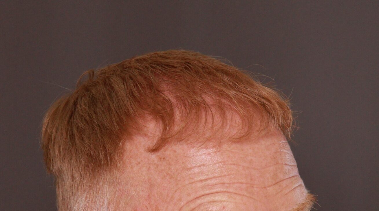 After Image: FUT Hair Transplant by Dr. Thompson - right-front-oblique