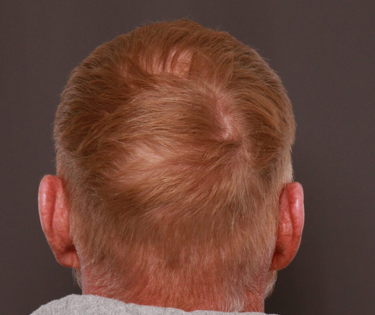 After Image: FUT Hair Transplant by Dr. Thompson - other