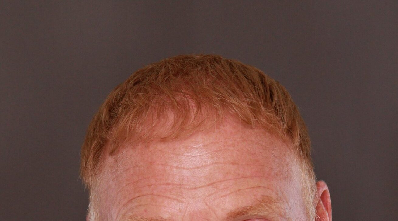 After Image: FUT Hair Transplant by Dr. Thompson - front