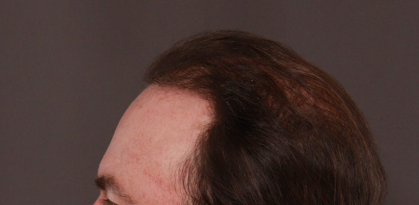 After Image: FUT Hair Transplant by Dr. Thompson - front