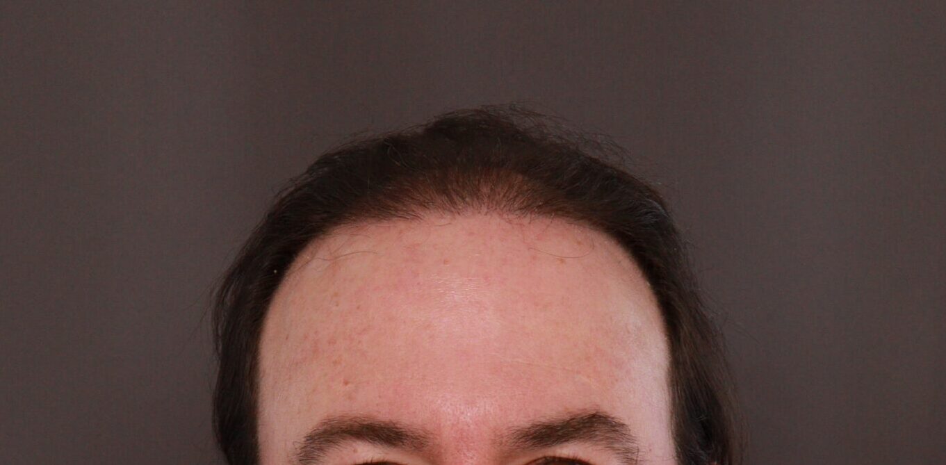 After Image: FUT Hair Transplant by Dr. Thompson - front