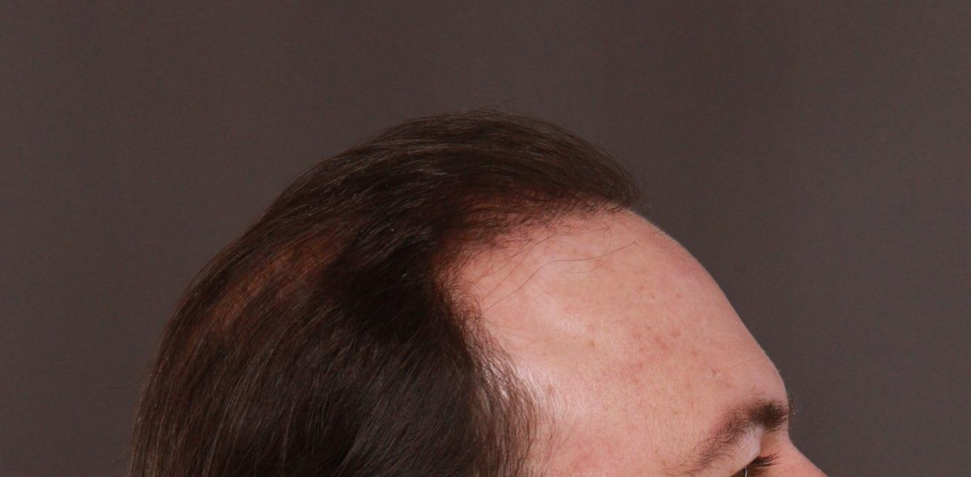 After Image: FUT Hair Transplant by Dr. Thompson - right-side