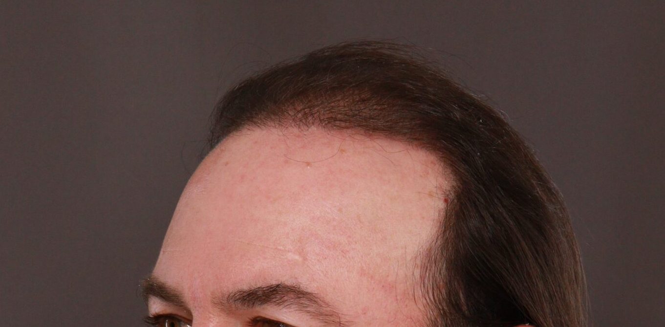 After Image: FUT Hair Transplant by Dr. Thompson - left-front-oblique
