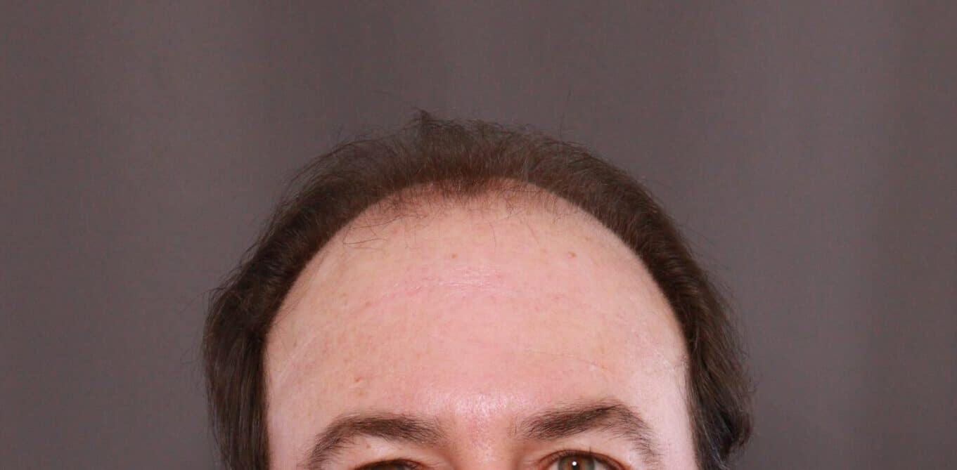 Before Image: FUT Hair Transplant by Dr. Thompson - front