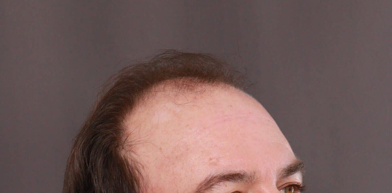 Before Image: FUT Hair Transplant by Dr. Thompson - right-front-oblique