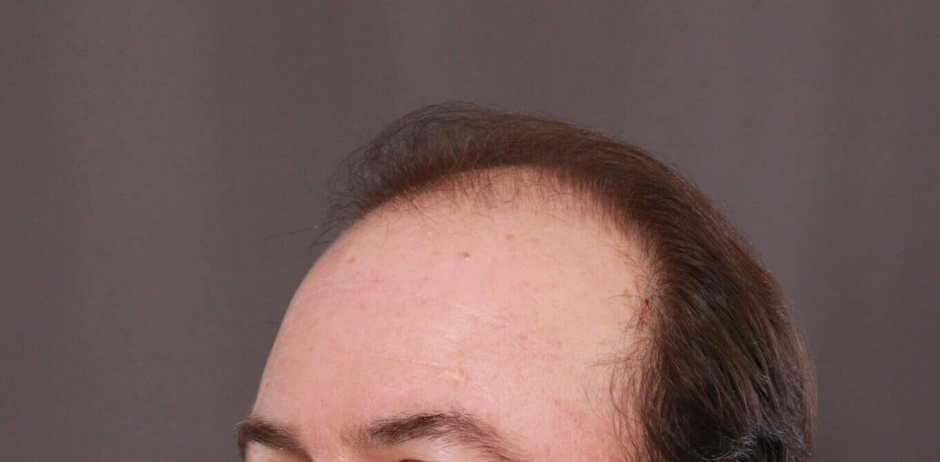 Before Image: FUT Hair Transplant by Dr. Thompson - left-front-oblique