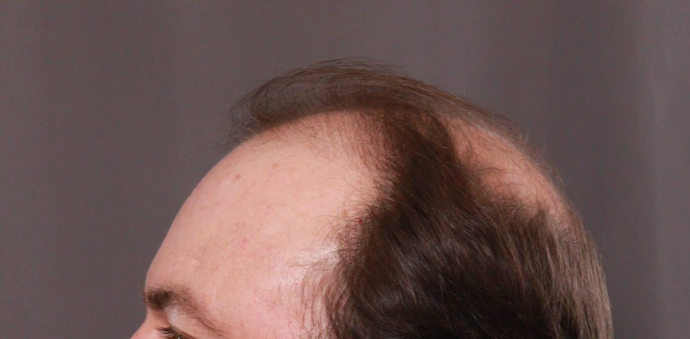 Before Image: FUT Hair Transplant by Dr. Thompson - front