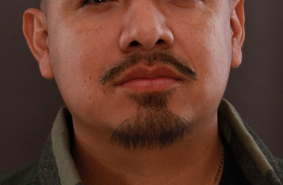 After Image: Mustache and Beard Transplant by Dr. Manning
