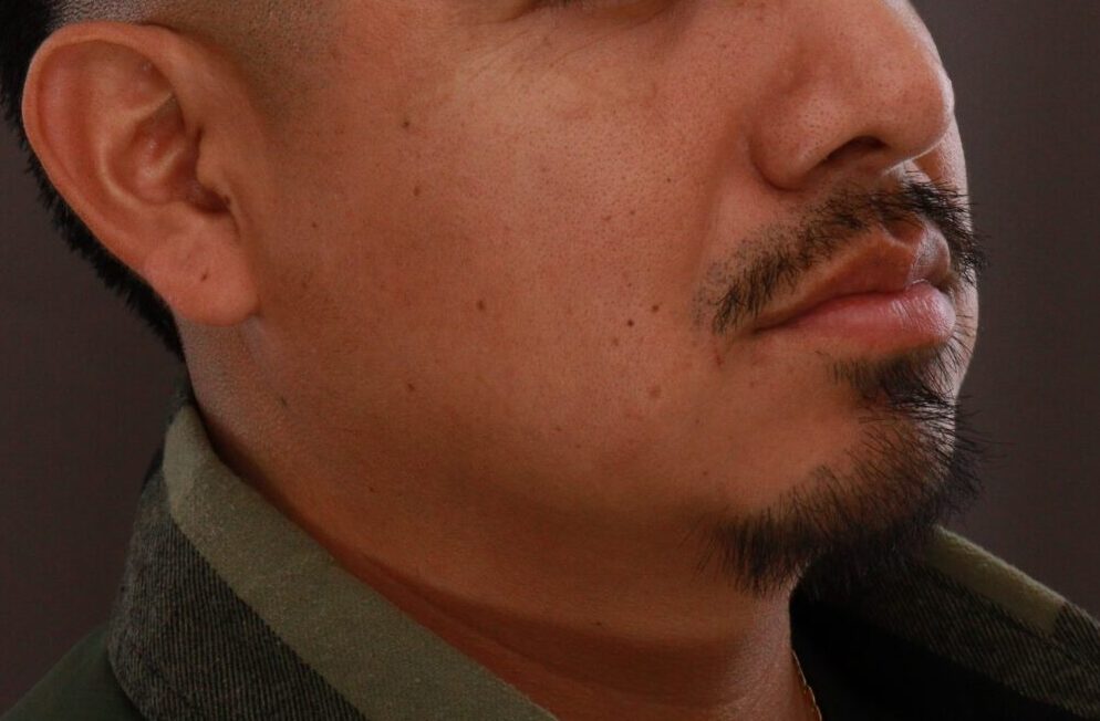 After Image: Mustache and Beard Transplant by Dr. Manning - right-front-oblique