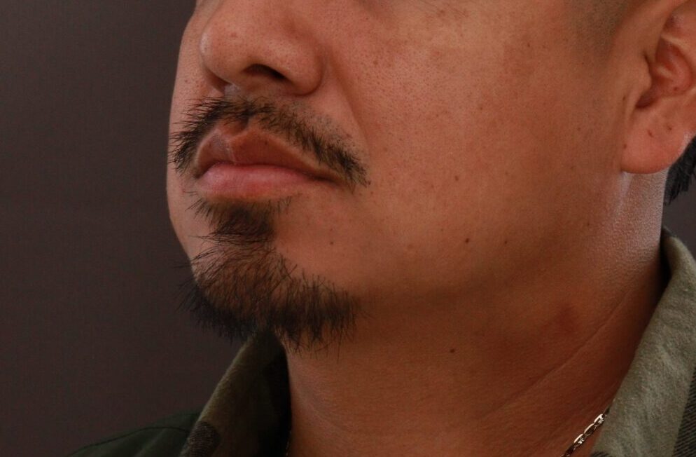 After Image: Mustache and Beard Transplant by Dr. Manning - left-front-oblique