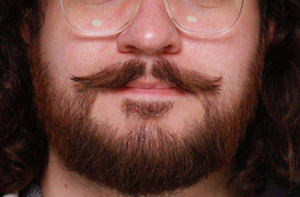 After Image: Mustache and Beard Transplant by Dr. Manning - front