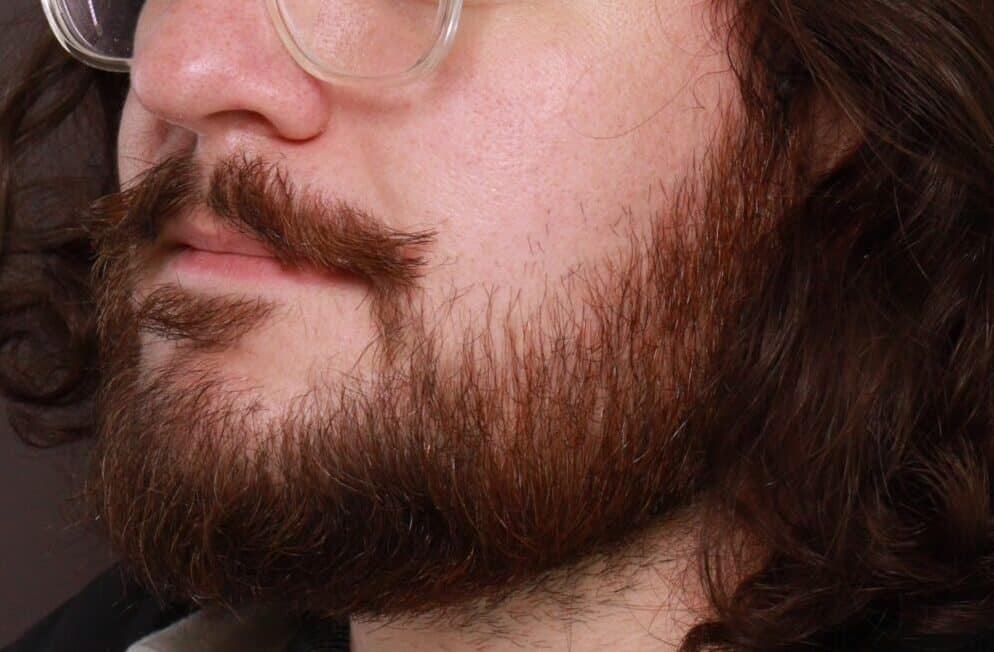 After Image: Mustache and Beard Transplant by Dr. Manning - left-front-oblique