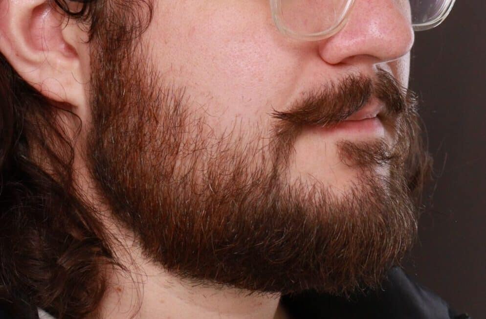 After Image: Mustache and Beard Transplant by Dr. Manning - right-front-oblique