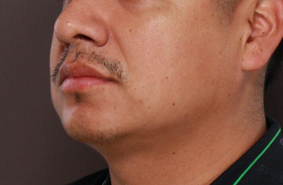 Before Image: Mustache and Beard Transplant by Dr. Manning - left-front-oblique