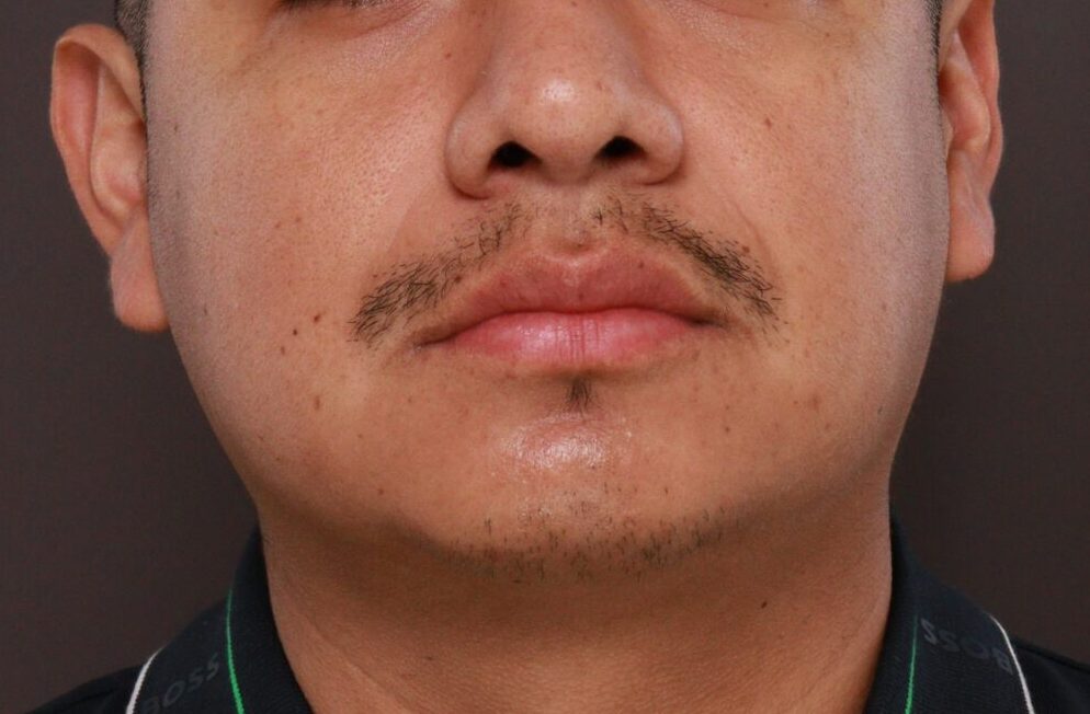 Before Image: Mustache and Beard Transplant by Dr. Manning