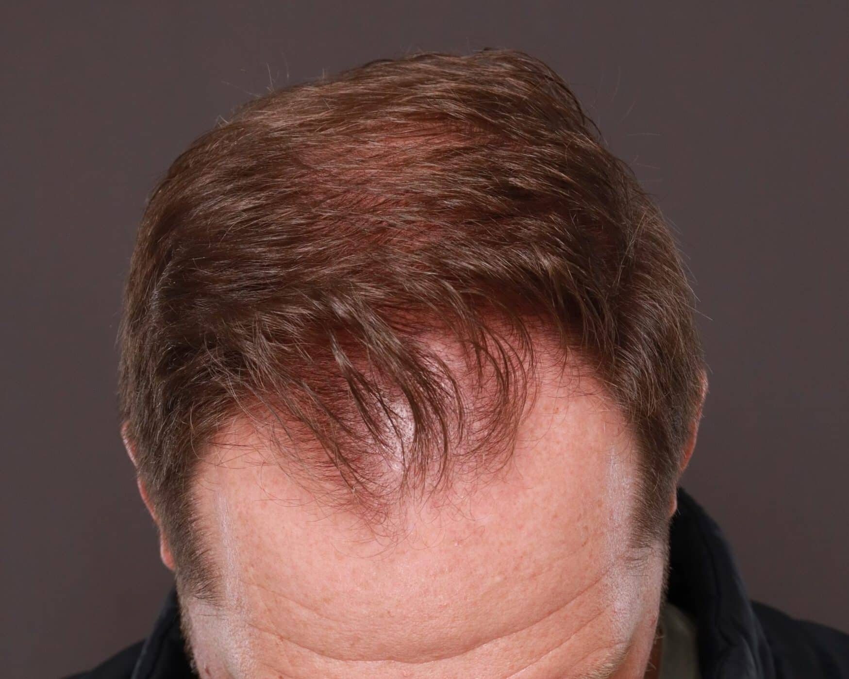 Before Image: FUT Hair Transplant by Dr. Thompson - front