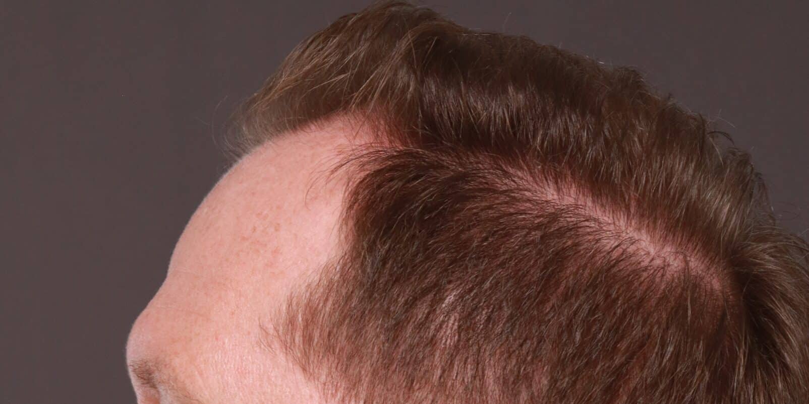 Before Image: FUT Hair Transplant by Dr. Thompson - left-side