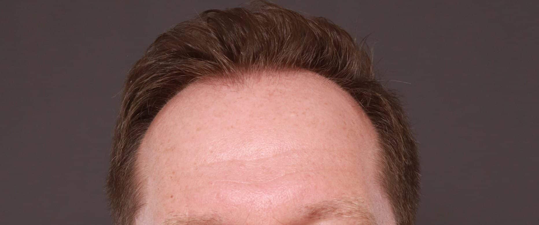 Before Image: FUT Hair Transplant by Dr. Thompson - front