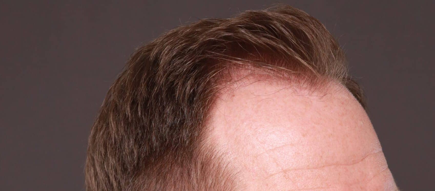 Before Image: FUT Hair Transplant by Dr. Thompson - right-front-oblique